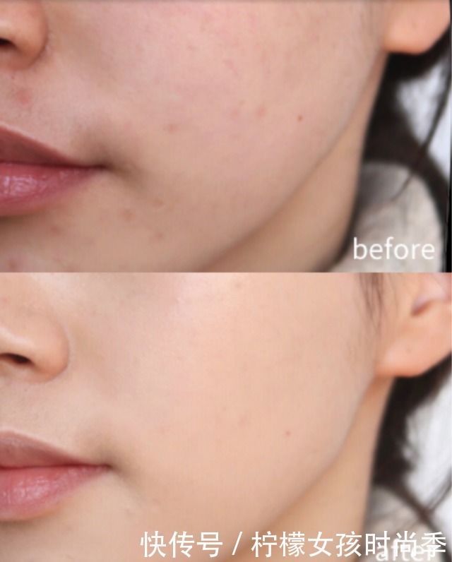 油皮|少走弯路!祛痘印用这几款平价好物就够了,拒绝“盲目跟风踩雷”