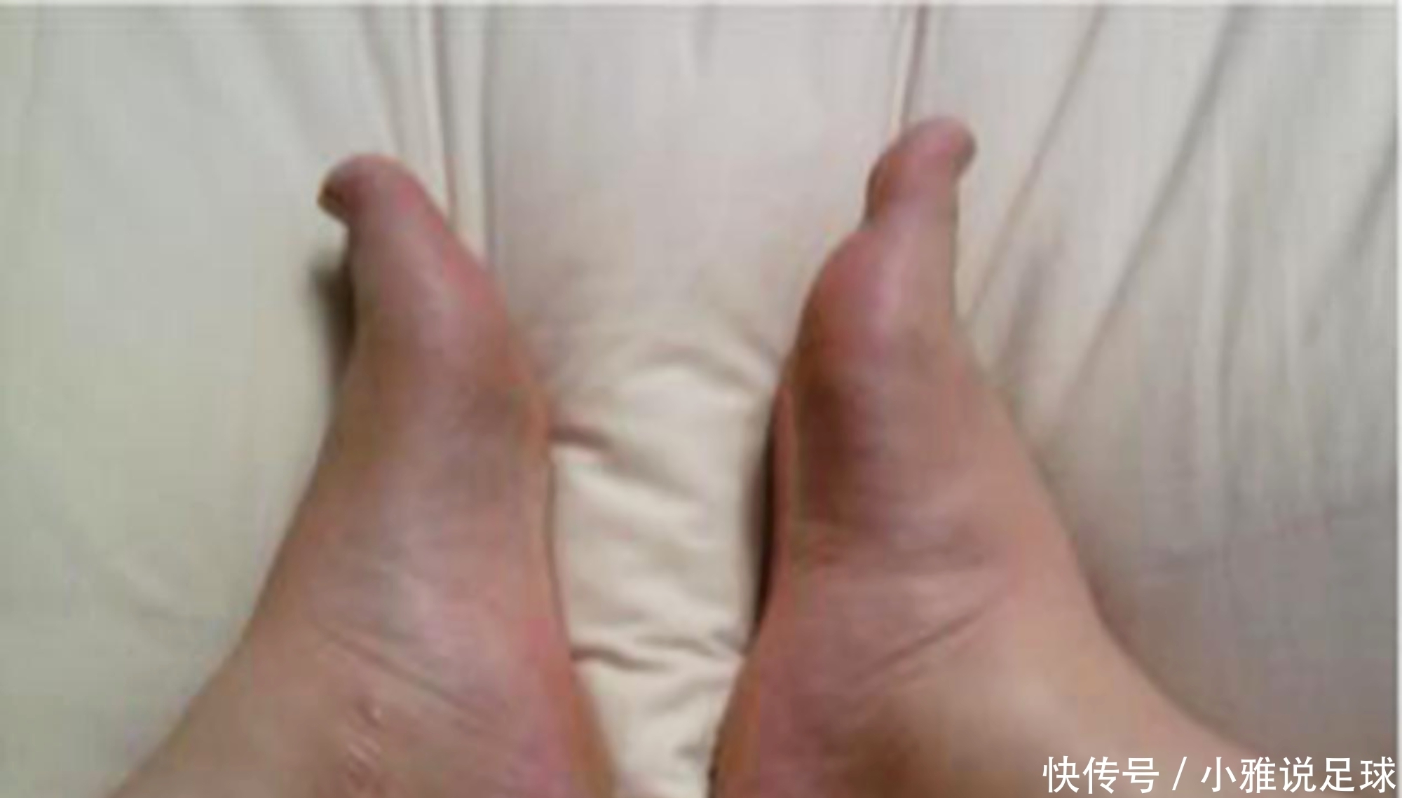 缓解|怀孕后脚肿、腿肿、全身肿?孕水肿缓解“四妙招”,效果立竿见影