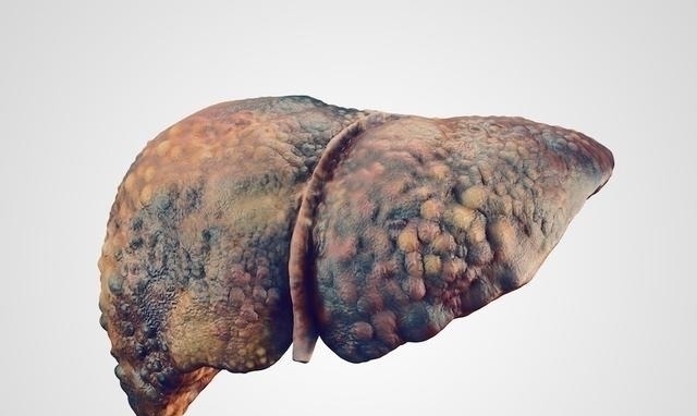 甲胎蛋白|肝炎加重,转氨酶直升,有2种食物是肝炎宿敌,吃了肝脏慢慢变好