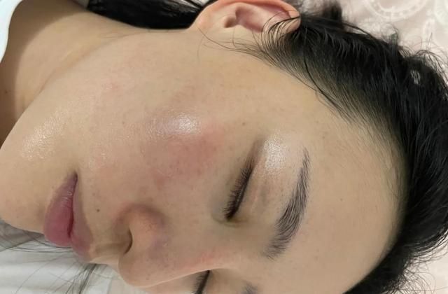 红血丝|判断你是不是“敏感肌”?看脸上这几个地方,很简单就能看出来!