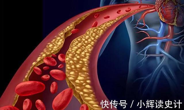 早餐|高血脂不能喝牛奶?医生提醒:想降血脂的人,3种早餐最好远离