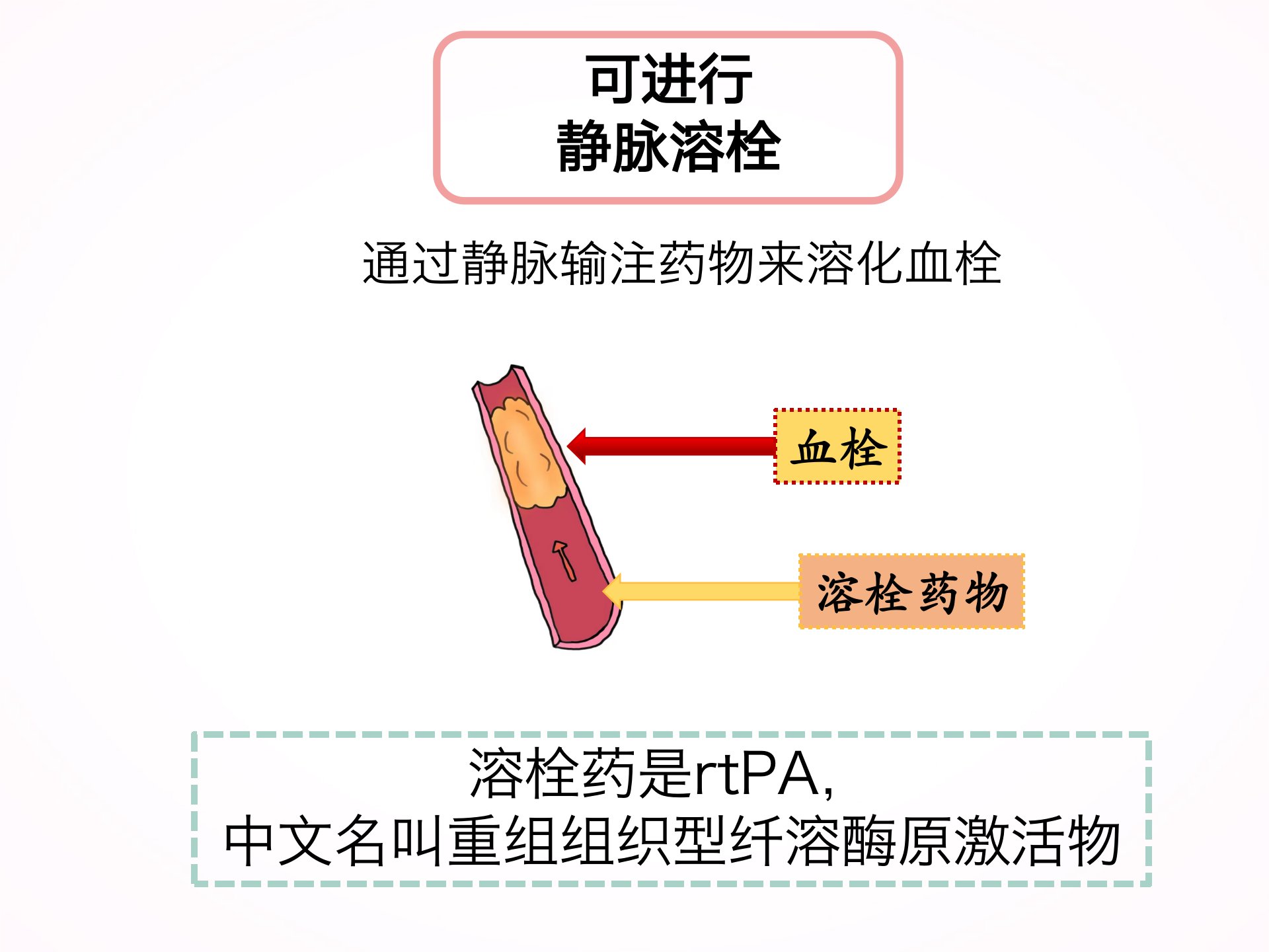 脑血管病|您为什么要选择静脉溶栓？