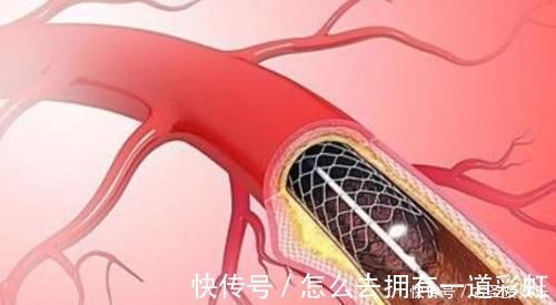 心脏病|心脏支架手术后,还可以活多久医生终于给出准确答案,早做准备
