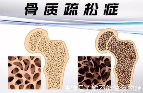 骨质疏松|燕麦与骨质疏松症有什么关系？保护好骨骼，尽量少吃这几种食物