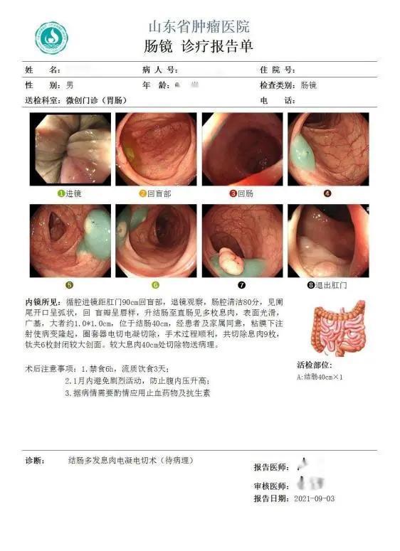 管状腺瘤|如何预防肠息肉癌变？粪便基因检测筛查，肠癌早诊早治是关键！