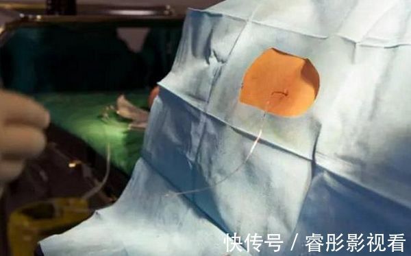 区别|剖腹产的半麻和全麻,到底有什么区别?后者关系到胎儿健康