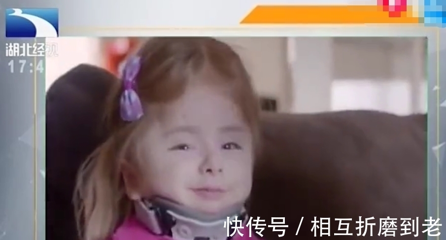 脆弱|最“脆弱”的女孩:1年骨折100多次,打个喷嚏都会骨折