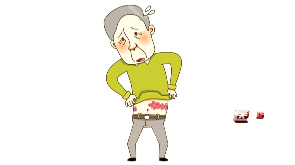 主任医师|蛇盘疮绕一圈就无药可救了?谣言!快来了解这种病
