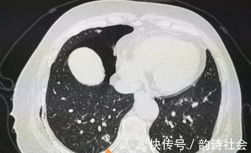 胸膜|癌症病人的幸运指数不一样，这位老太太想感谢一个吹破的肺大泡