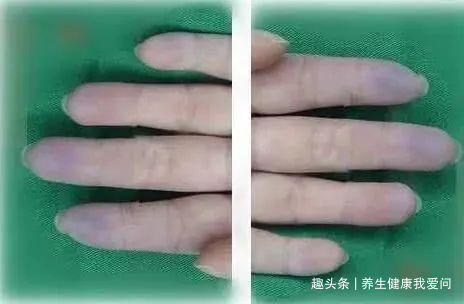 高血脂|寿命短的女人，手上会发出3种信号，若一个不占，说明你还算健康