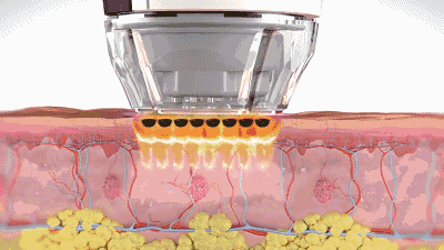 皮肤 光子嫩肤都能解决哪些皮肤问题?丨科普篇