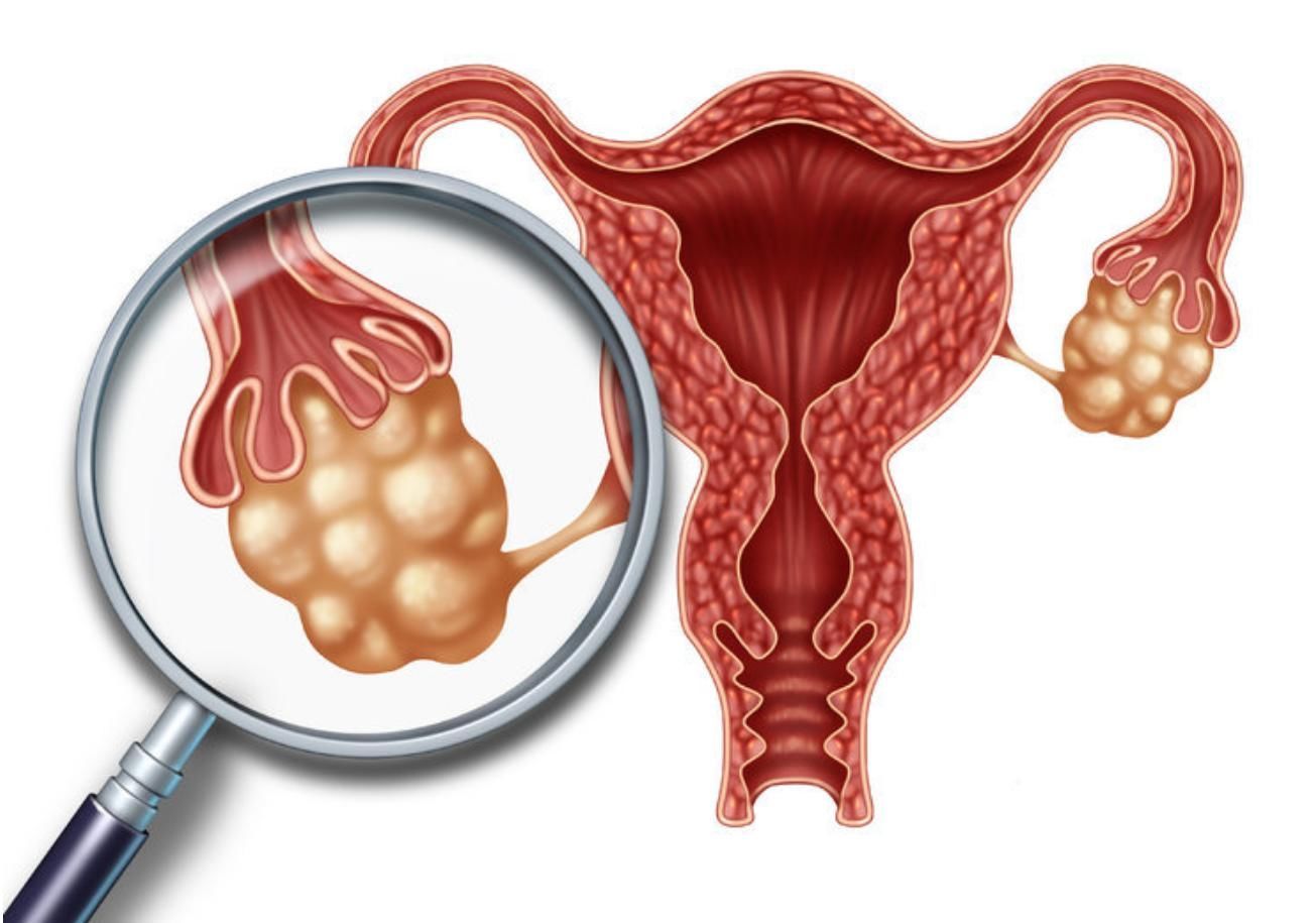 药物治疗|“搞定”子宫肌瘤，3个方法任你选，别一拖再拖