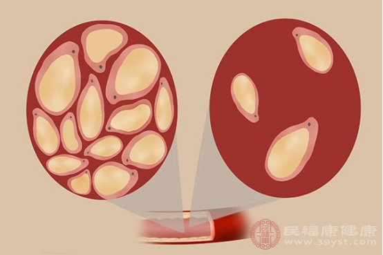 甘油三酯高怎么降下来