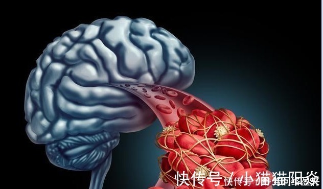 常吃|脑供血不足真凶找到了！常吃3物，多做2动作，早坚持血管早安全