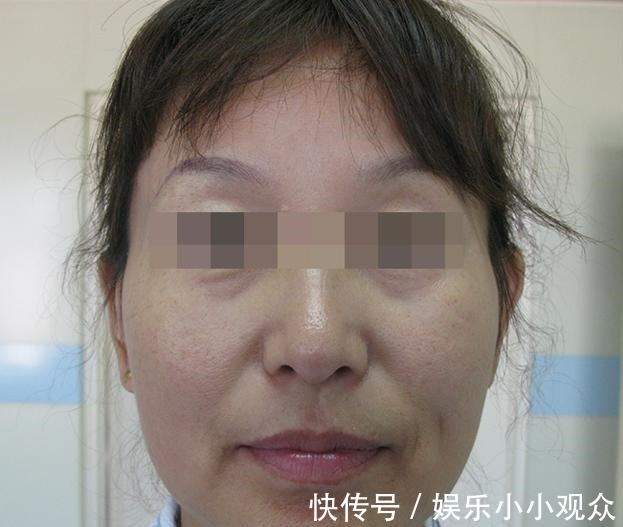 皮肤 46岁做拉皮手术是种什么体验,分享一下我的真实经历!