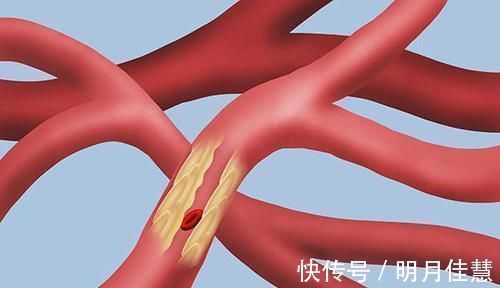 管道|长期运动，血栓就能没了？内科医生：想要“溶栓”，1件事少不了