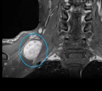 磁共振|医院先后来了两个男子,毛病几乎一样脖子上长了“鹌鹑蛋”,按按手还有触电的感觉……
