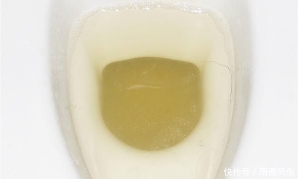 肝功能|上厕所时,若出现4个症状,或和肝癌有关,医生需留心观察