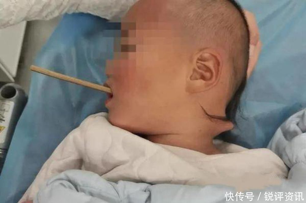孩子|看着太揪心!2岁多孩子的脖子被一根筷子戳穿!