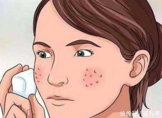 激光|激光祛痘印怎么样?关于祛痘印的方法这些你应该知道