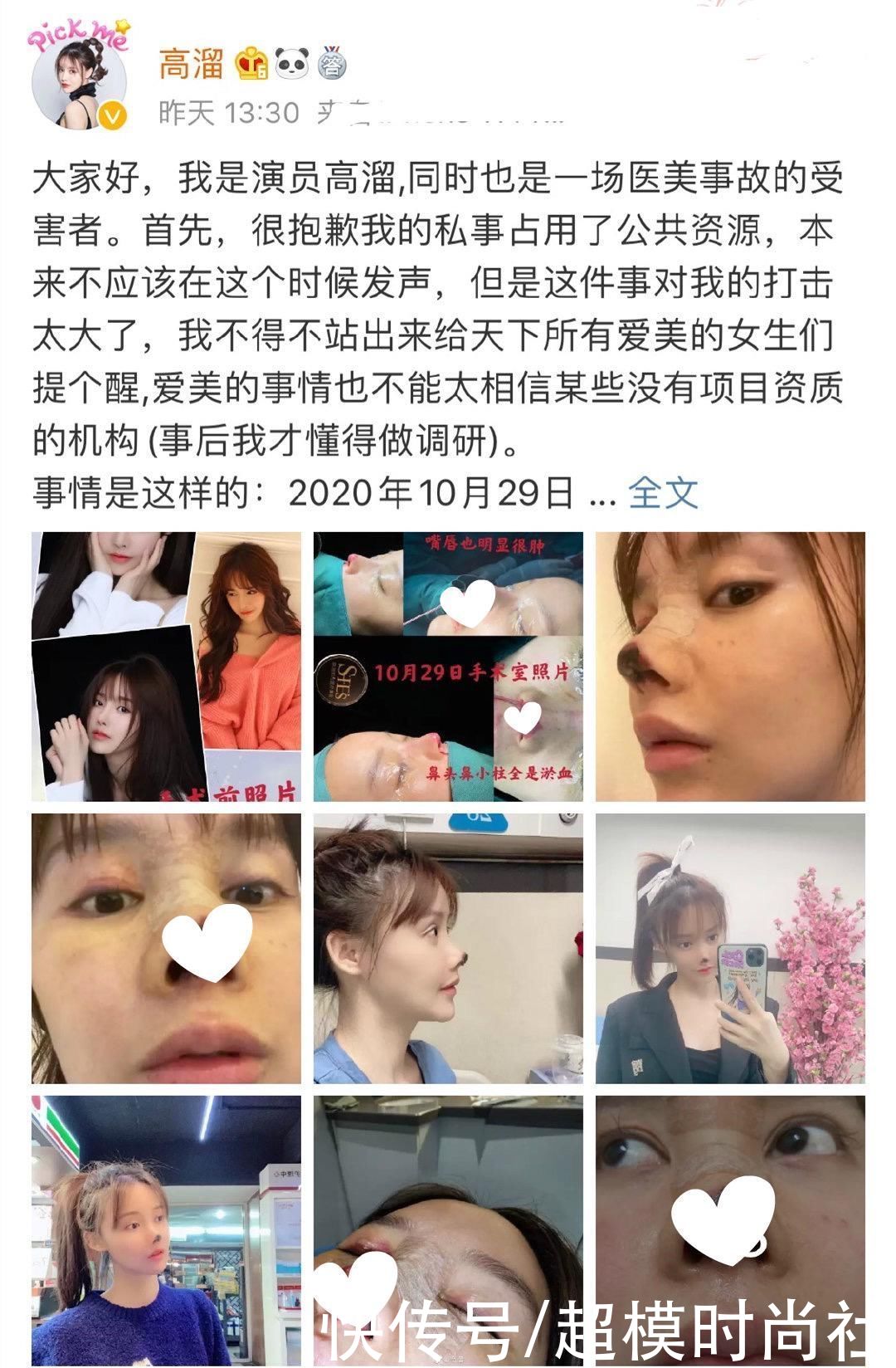 演员高溜整容鼻尖坏死！本是清纯风长发美女，成网红脸没了辨识度