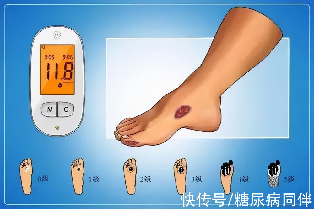 糖尿病|糖尿病人有四个症状,当心引发足病造成截肢
