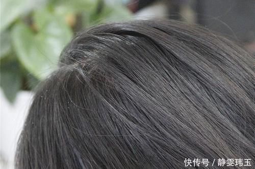 营养素|脱发、头发毛躁、白发?专家:头发出问题,多半是缺乏3种营养素