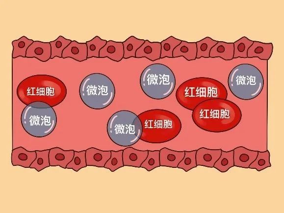 “小微泡，大用途”，说说超声造影那些事儿！|仁济科普 | 检查