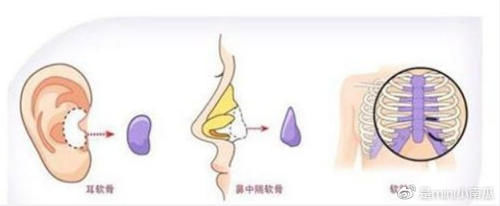 鼻部整形真的安全吗？假体隆鼻材料硅胶和膨体哪个更自然持久？