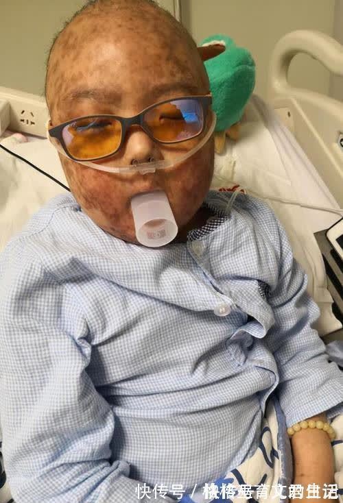 家长|6岁男童身患白血病,长出“蛇皮”,生前说出的这18个字让母亲痛哭