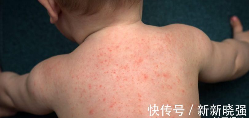 绿豆|十大食物过敏排行榜出炉!小麦、鳝、蛋黄为儿童过敏食物前三名!