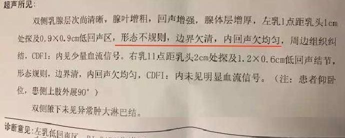 卵巢囊肿|结节、息肉、囊肿是癌症先兆吗？北肿专家们说出了真相！