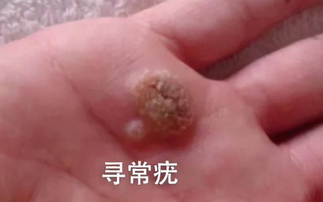 hpv|皮肤上长这种「小疙瘩」，可能和HPV感染有关……