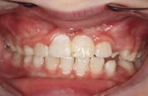 牙医|孩子换牙齿,新长的牙齿却是歪的,可能是家长这些没做好