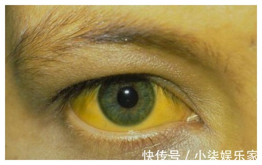 肝癌|42岁男子,肝硬化到肝功正常,只用了1年,平时爱吃“1红”是关键