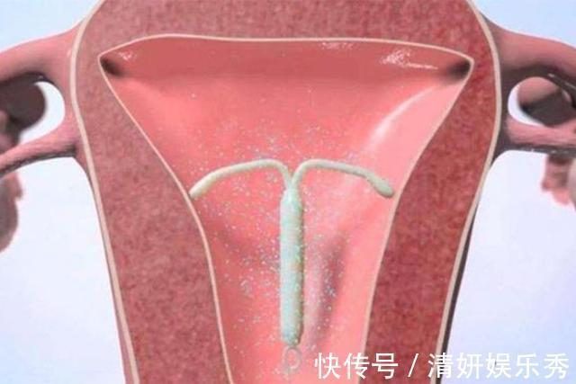 避孕|35岁宝妈“上环”十年整,到医院取下环的一瞬间,医生在心疼她
