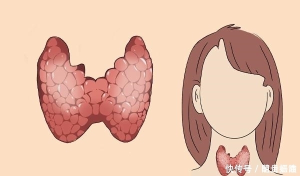 禁忌|甲状腺结节并非“善类”避免结节反复,应少吃这4类食物