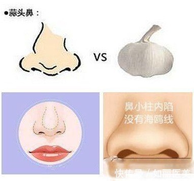 软骨 蒜头鼻光靠鼻头鼻翼缩小手术效果不明显!需做鼻综合来改善
