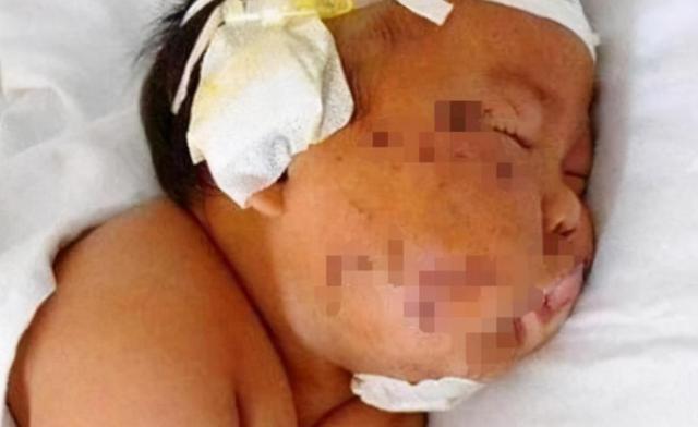 吃奶|5年前因吃奶太用力,被妈妈刮成“花脸猫”的宝宝,如今怎么样了