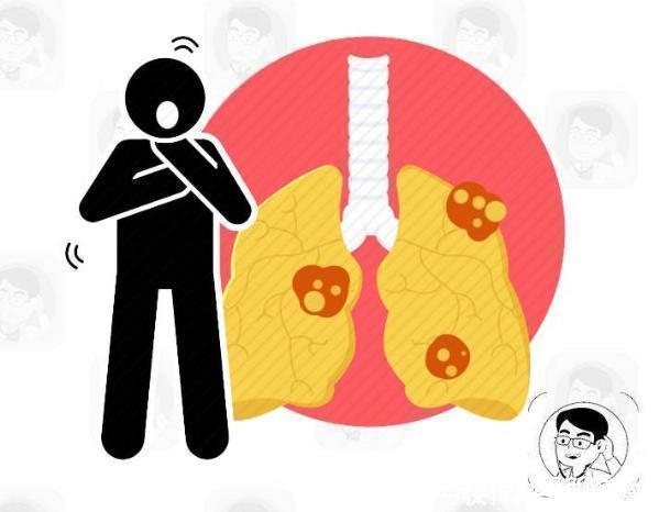 喉返神经|肺癌除了胸痛外,若还有这4个表现,警惕癌症已到中晚期