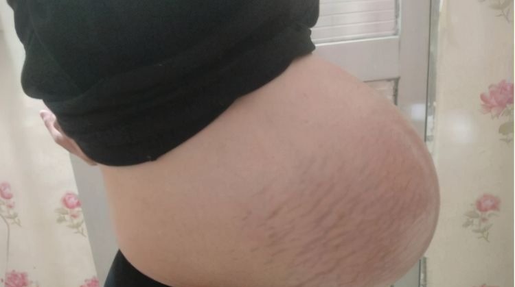 悬垂肚|孕妇“悬垂肚”走红,头回见到这种胎型,护士坦言:对宝妈不好