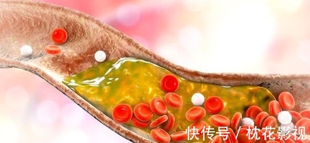 高血脂症|高血脂的“源头”已发现,专家呼吁:停止食用“2物”,远离脑梗