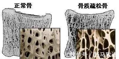 类风湿|类风湿患者：不补钙，当心再也站不起来