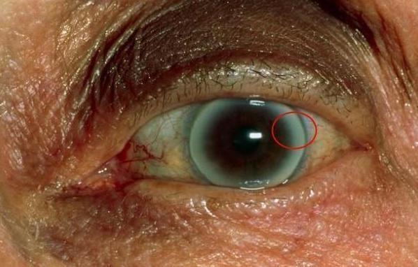 丰隆穴|血脂高的人,眼睛可能有3个症状,若没有,说明血脂控制的还不错