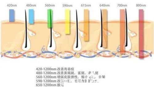 皮肤 光子嫩肤种类那么多，为什么建议使用OPT技术的仪器