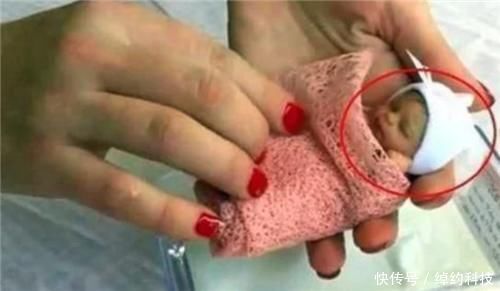 早产儿|18年了,那个出生仅280克的女婴,曾打破世界纪录,如今还活着