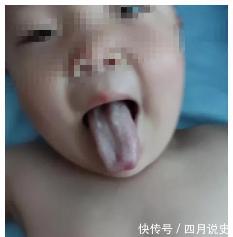 长高|孩子这样的舌苔,是很难长肉长高的