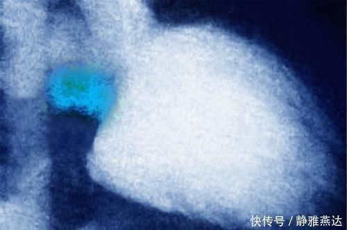 高血糖|糖尿病,最可怕的是并发症!牢记3方法,让血糖高的人远离并发症