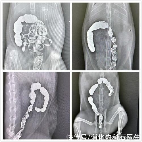 老王|便秘老人考虑胃癌，却因为钡餐检查遭受痛苦，钡餐检查还能做吗?