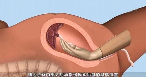 海豚|产妇生完孩子半小时，医生再次伸手进去，产妇大怒却被回怼为你好